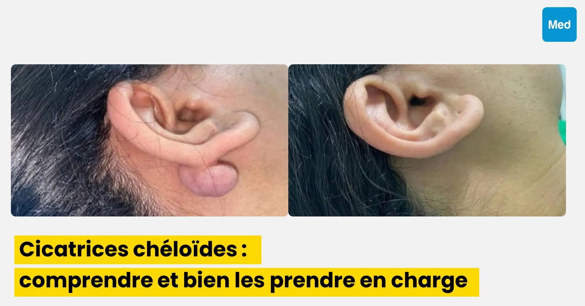 Cicatrices chéloïdes : comprendre et bien les prendre en charge